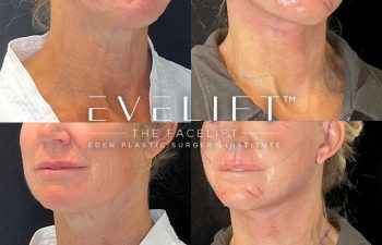 female patient before and after EVELift®