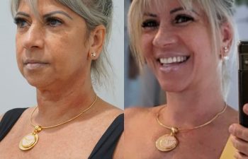 female patient before and after EVELift®