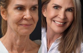 female patient before and after EVELift®