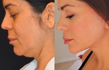 female patient before and after EVELift®