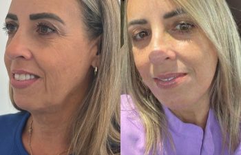 female patient before and after EVELift®