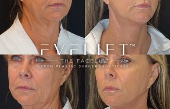 female patient before and after EVELift®