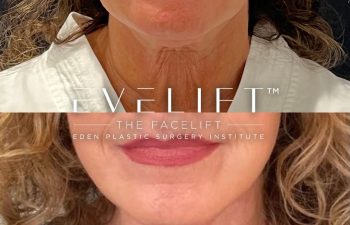 female patient before and after EVELift®
