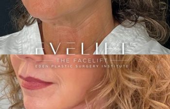 female patient before and after EVELift®
