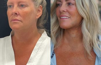 female patient before and after EVELift®