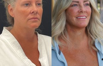 female patient before and after EVELift®