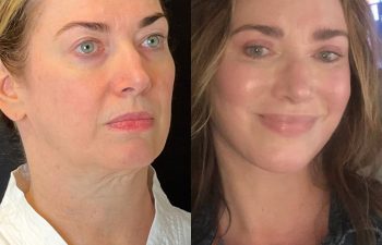 female patient before and after EVELift®