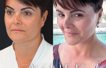female patient before and after EVELift®