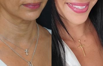 female patient before and after EVELift®