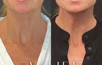 female patient before and after EVELift®