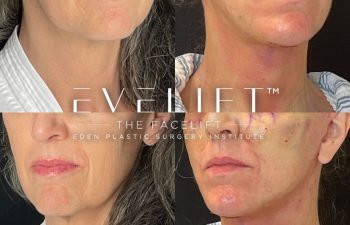 female patient before and after EVELift®