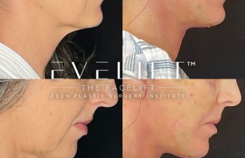 female patient before and after EVELift®