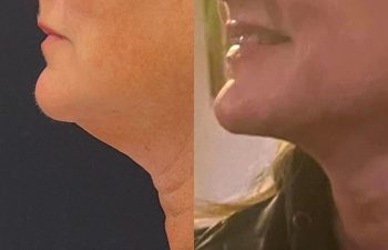 female patient before and after EVELift®