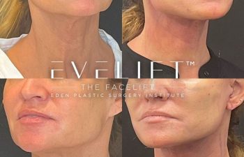 female patient before and after EVELift®