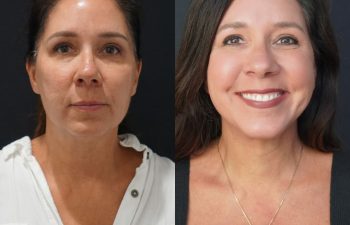 female patient before and after EVELift®