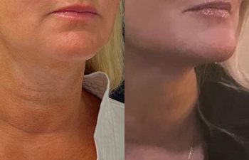 female patient before and after EVELift®