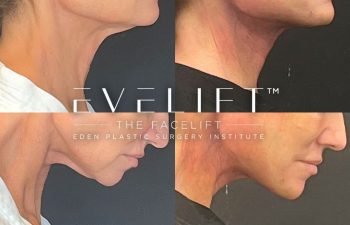 female patient before and after EVELift®