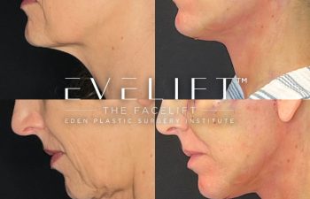female patient before and after EVELift®
