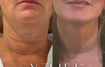 female patient before and after EVELift®