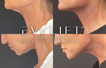 female patient before and after EVELift®
