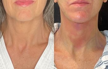 female patient before and after EVELift®