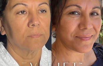 female patient before and after EVELift®