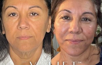 female patient before and after EVELift®