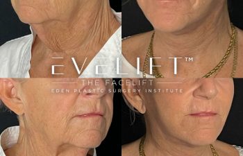 female patient before and after EVELift®