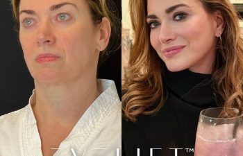 female patient before and after EVELift®