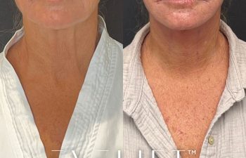 female patient before and after EVELift®