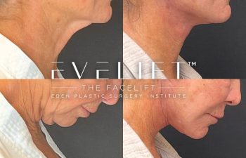 female patient before and after EVELift®