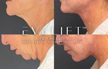 female patient before and after EVELift®