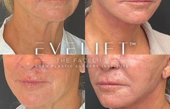 female patient before and after EVELift®