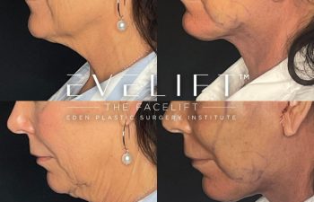 female patient before and after EVELift®