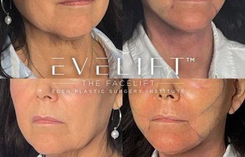 female patient before and after EVELift®
