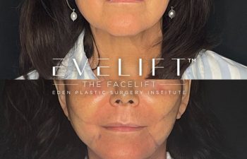 female patient before and after EVELift®