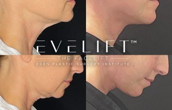 female patient before and after EVELift®