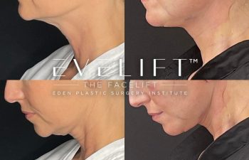 female patient before and after EVELift®