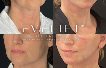 female patient before and after EVELift®