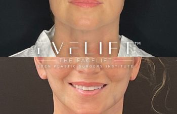 female patient before and after EVELift®