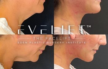 female patient before and after EVELift®