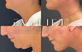female patient before and after EVELift®