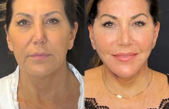 female patient before and after EVELift®