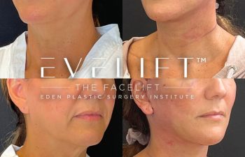 female patient before and after EVELift®
