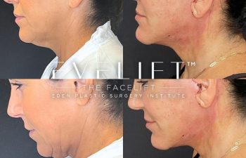 female patient before and after EVELift®
