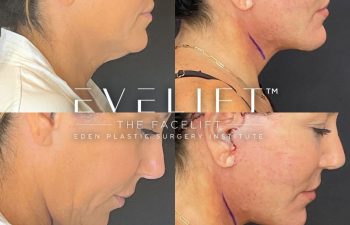 female patient before and after EVELift®
