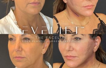 female patient before and after EVELift®