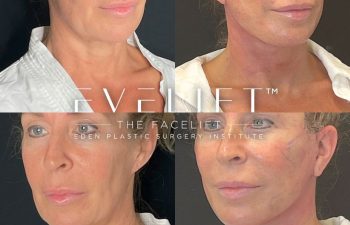 female patient before and after EVELift®