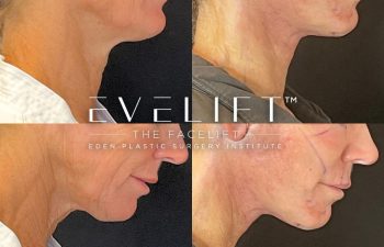 female patient before and after EVELift®