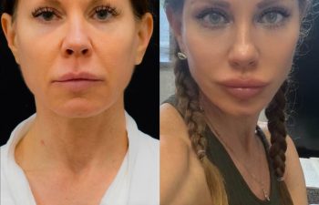 female patient before and after EVELift®
